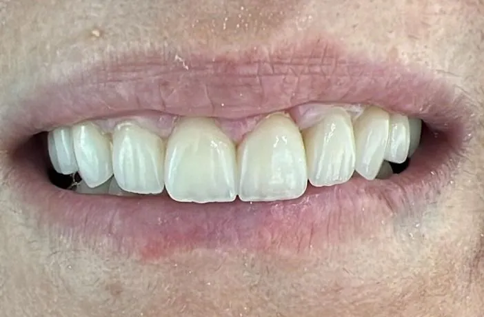 Facettes Emax naturelles : un Hollywood Smile au naturel après