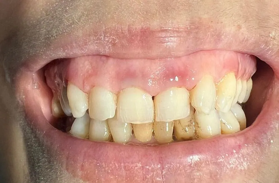 Facettes Emax naturelles : un Hollywood Smile au naturel avant