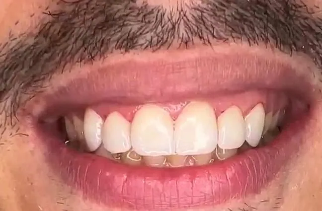6 facettes Emax sans préparation des dents (prepless) après