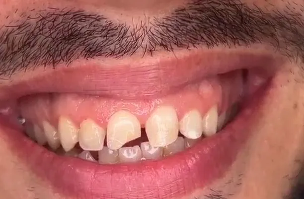 6 facettes Emax sans préparation des dents (prepless) avant
