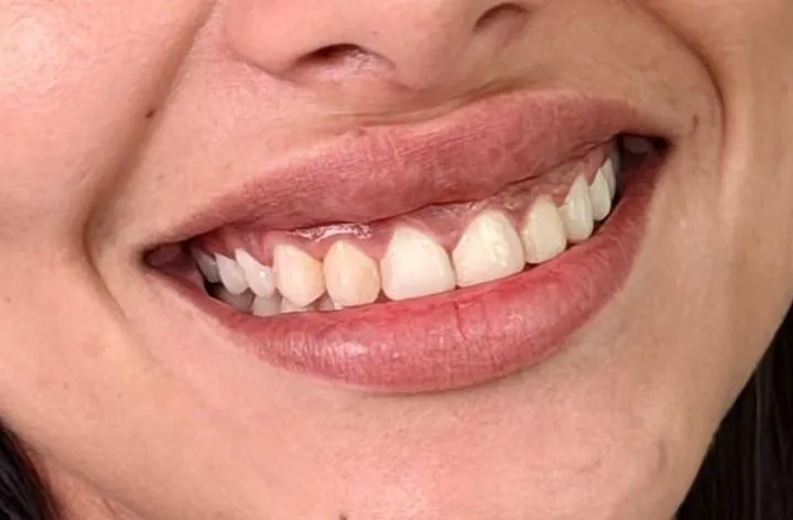 Hollywood Smile en facettes Emax avant