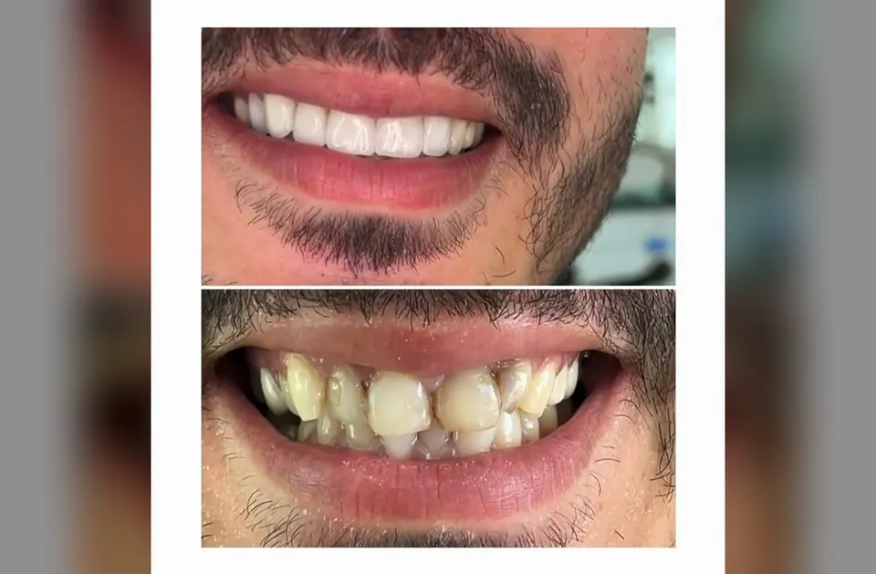 Hollywood Smile en facettes Emax, avant et après en vidéo