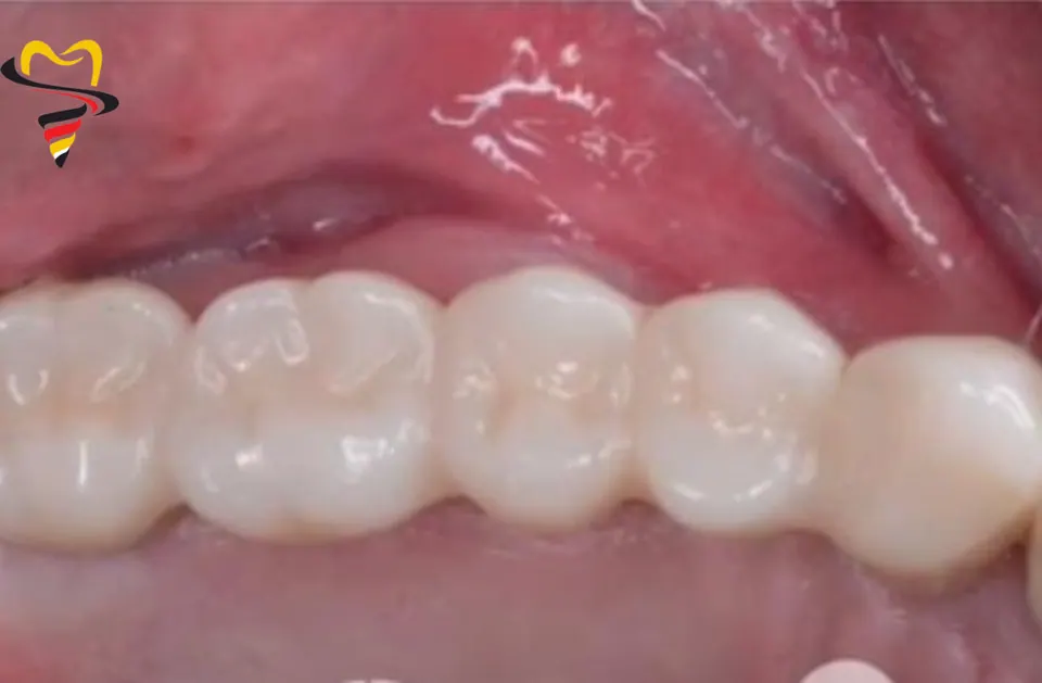 Après pose d'implant dentaire et couronne