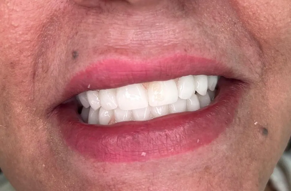 Extraction des dents infectées et 6 implants en haut et en bas, provisoires posés le jour même après