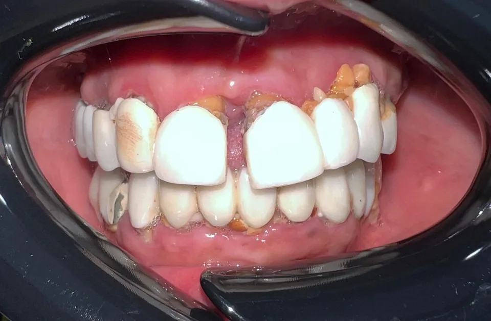 Extraction des dents infectées et 6 implants en haut et en bas, provisoires posés le jour même avant